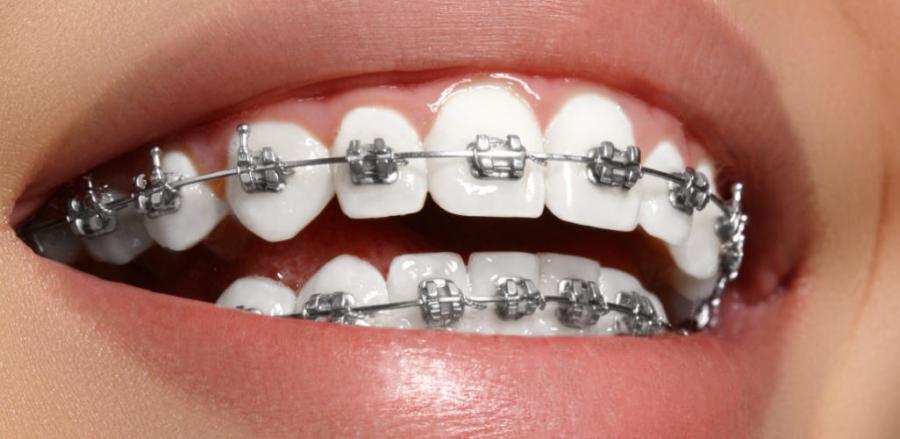 Types of Braces